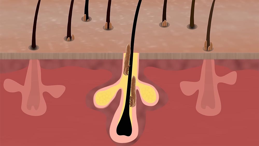 درمان انگل دمودکس مو