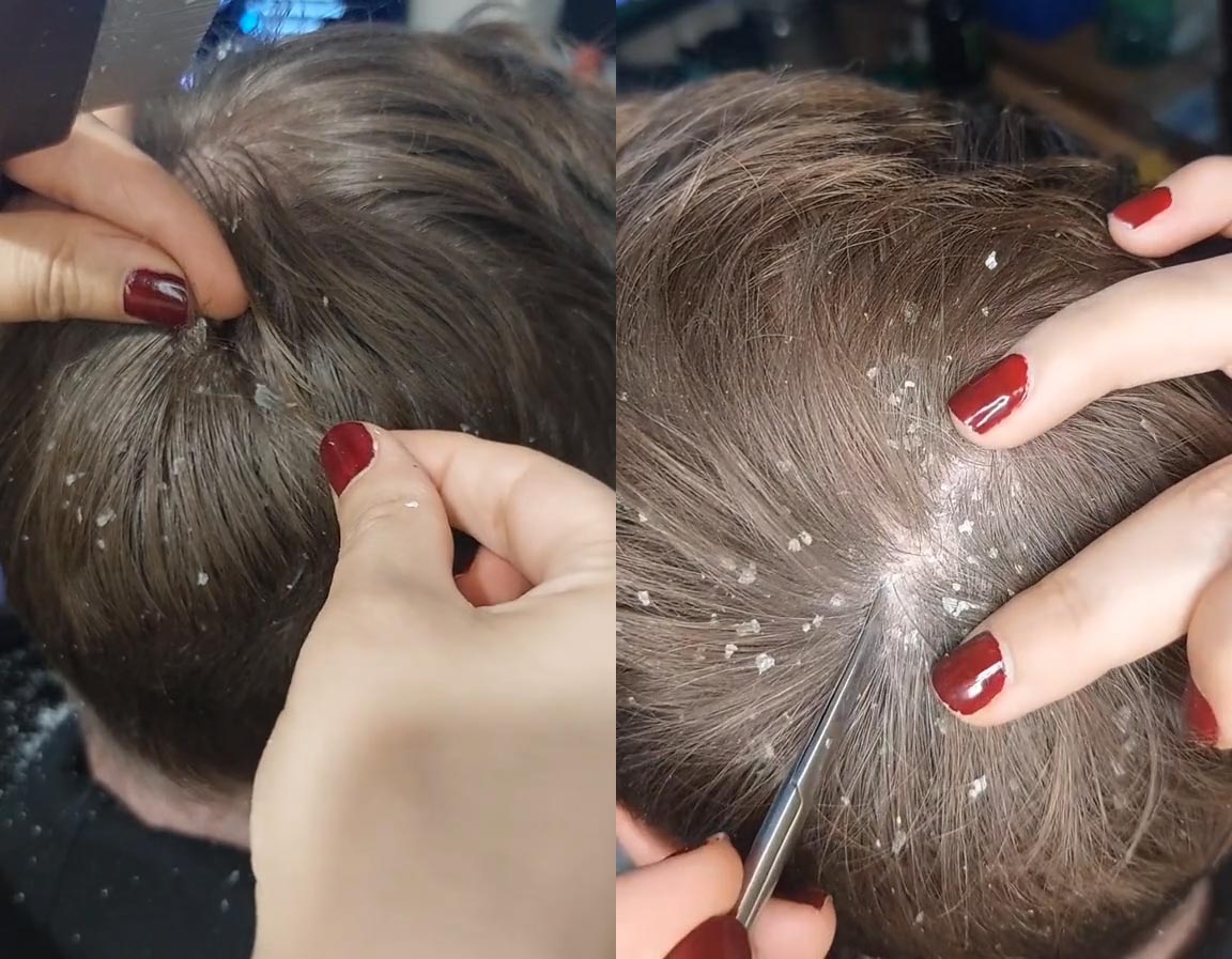 علائم انگل دمودکس