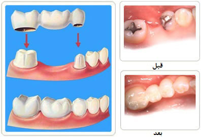 پروتز دندان