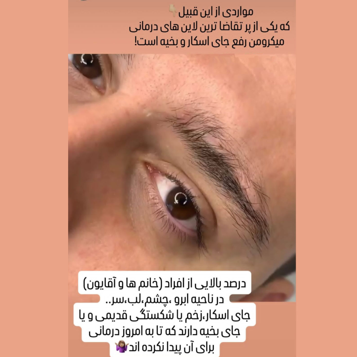 آیا بیماری پسوریازیس برای میکروبلیدینگ ابرو مشکل ایجاد می کند ؟