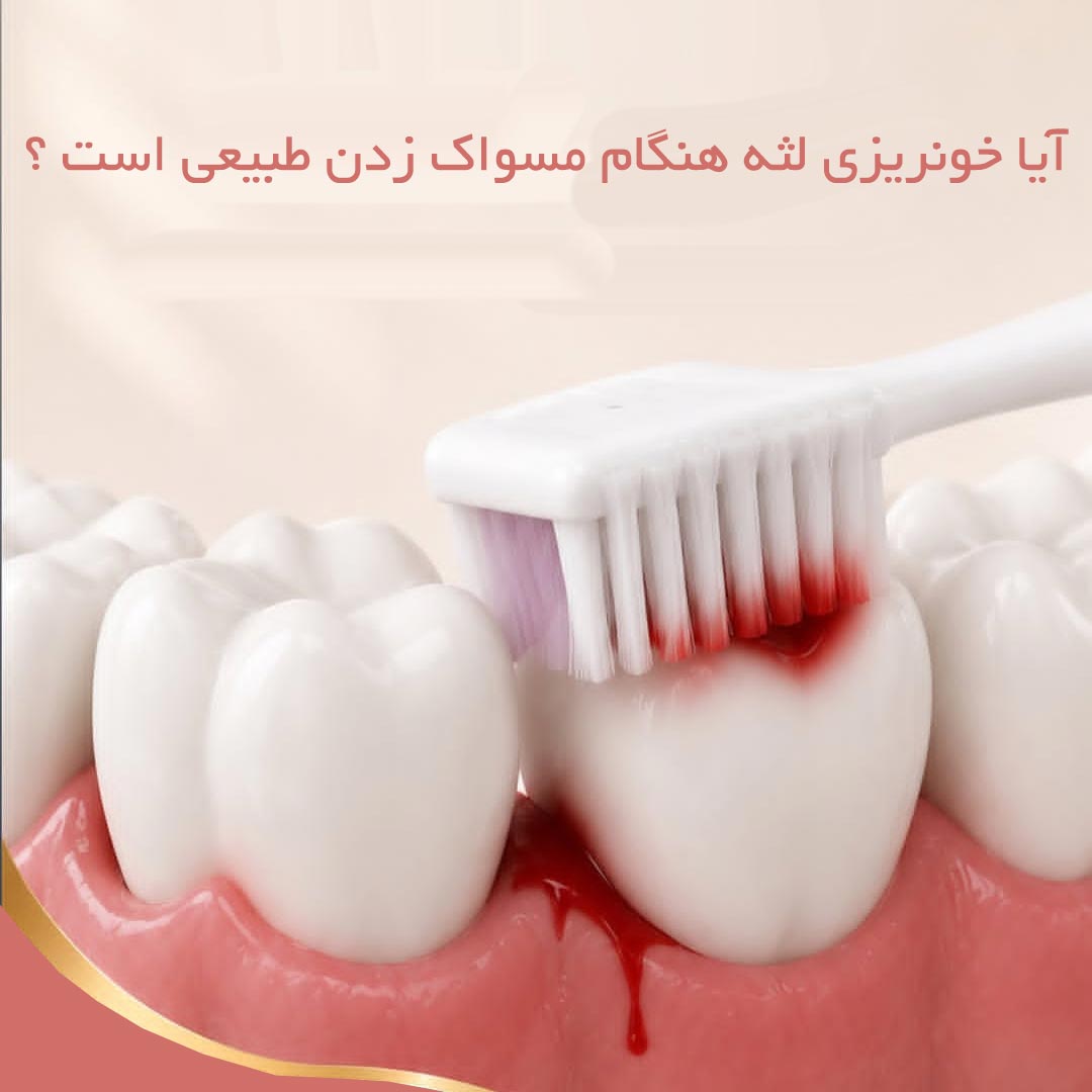 آیا خونریزی لثه هنگام مسواک زدن طبیعی است ؟