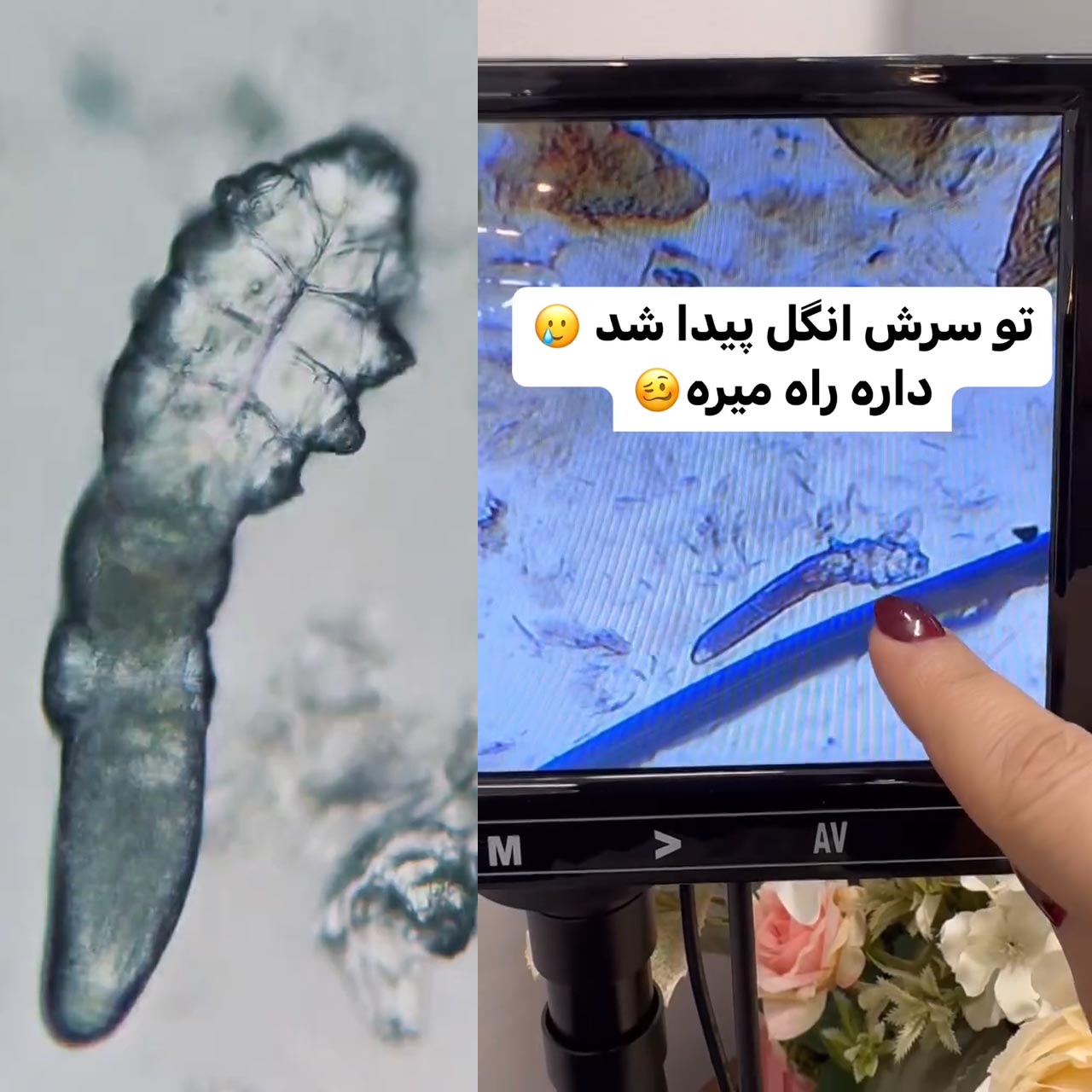 انگل دمودکس چیست + علائم و درمان