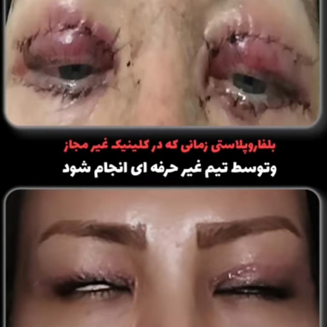 بلفاروپلاستی عکس قبل و بعد عمل افتادگی پلک