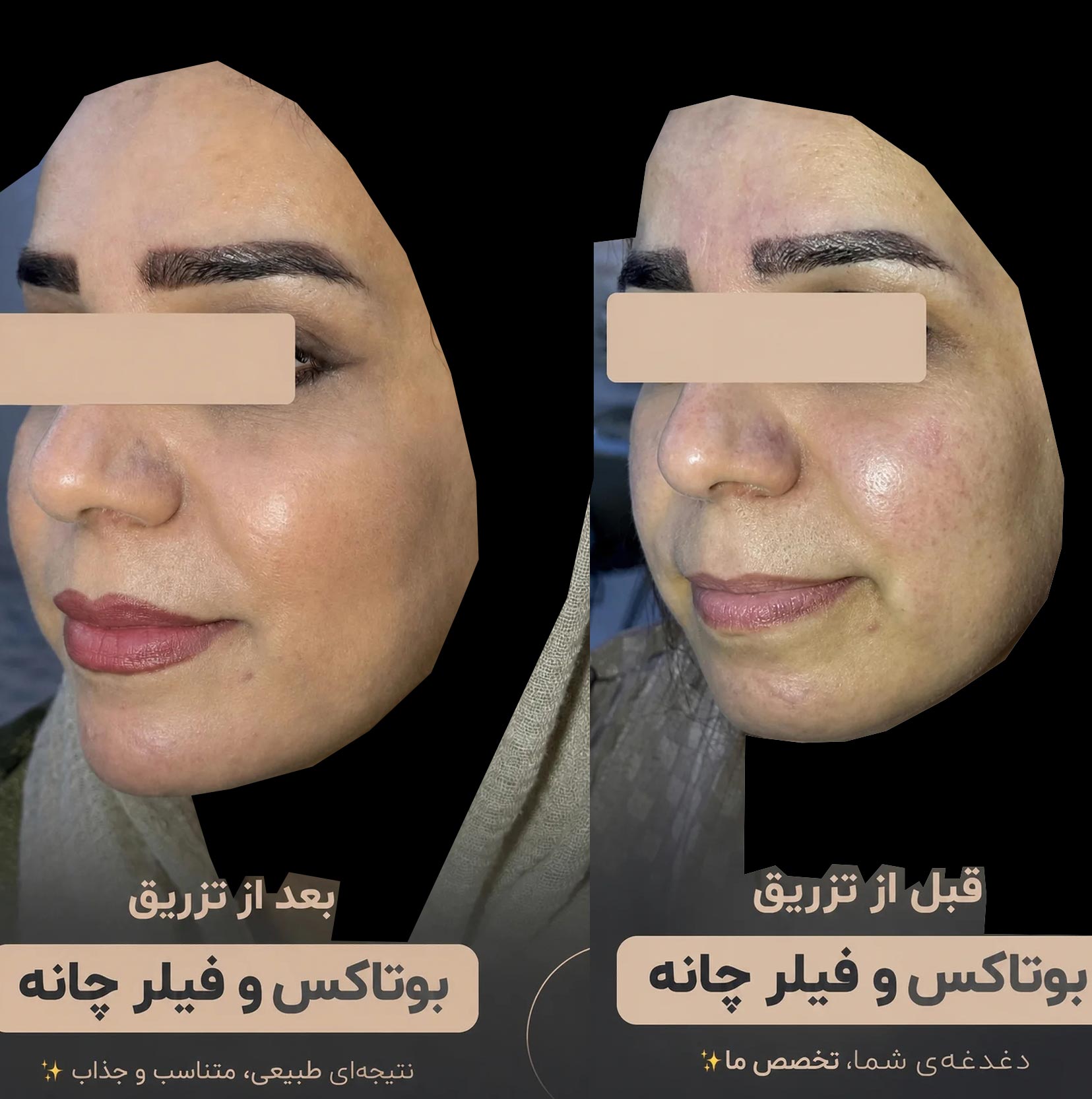 بوتاکس و فیلر چانه با نتیجه طبیعی + عکس قبل و بعد