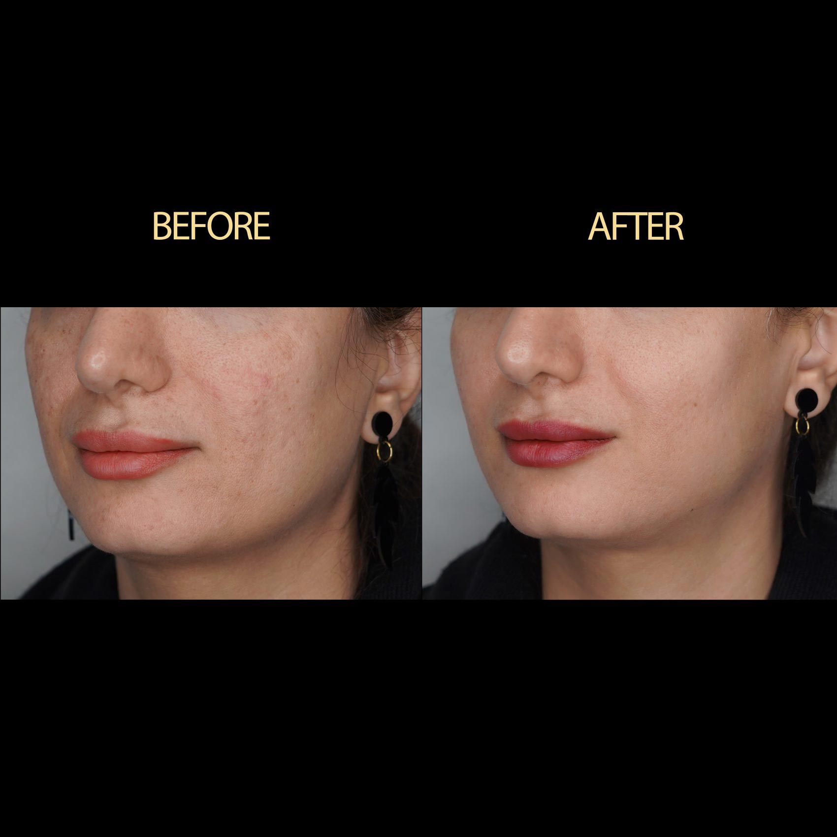 تاثیر مزوژل بعد از چند روز