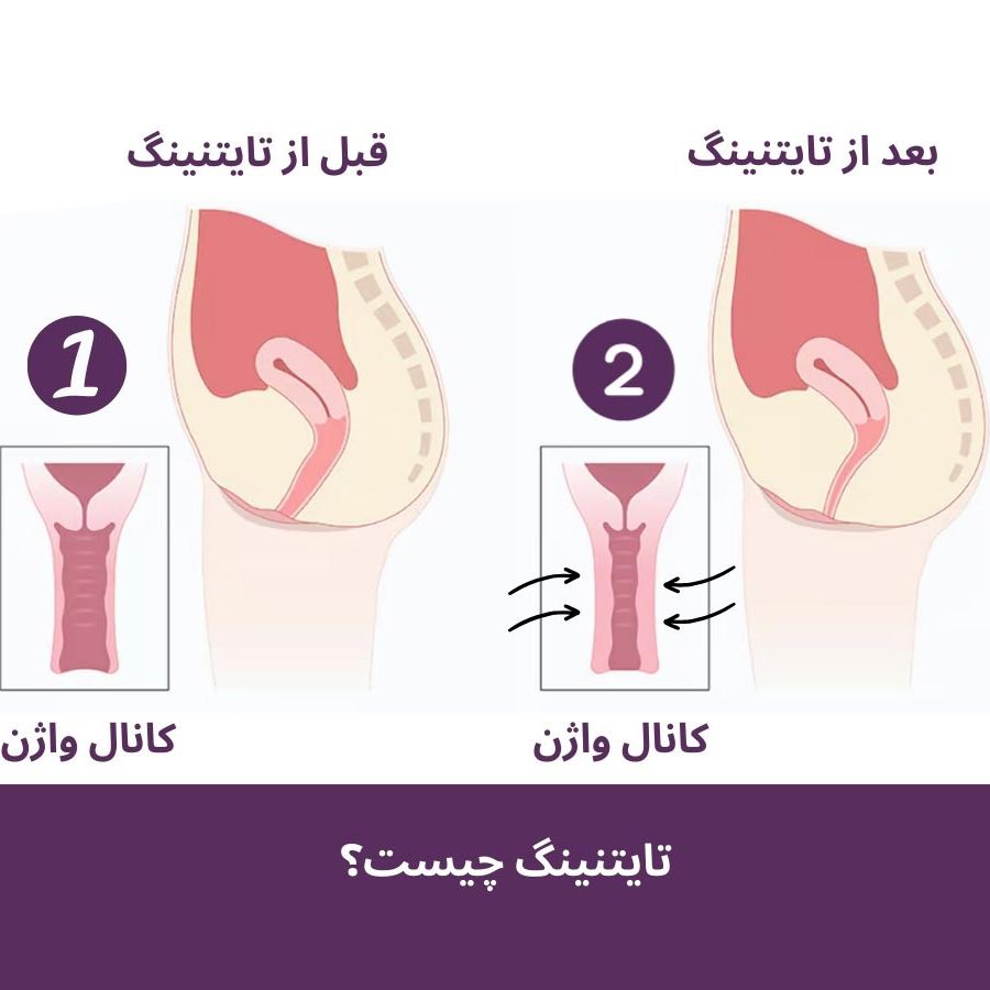 تایتنینگ واژن و پوست چیست + مراقبت های بعد