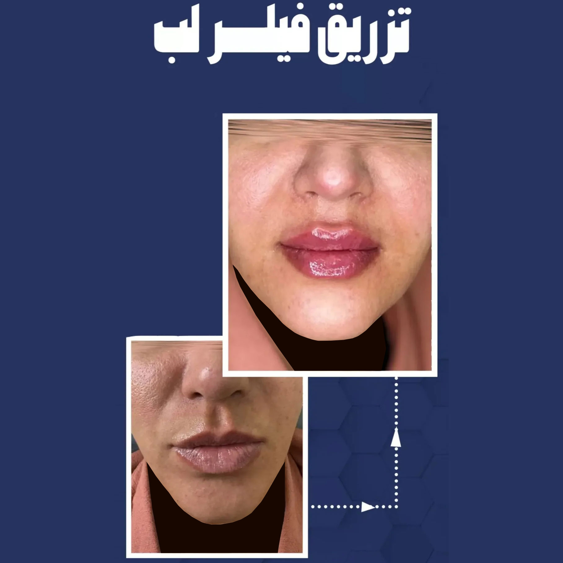تزریق فیلر لب + عکس قبل و بعد