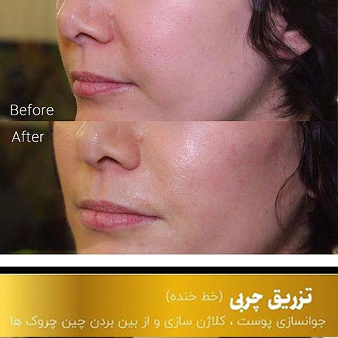 تزریق چربی به صورت چقدر ماندگاری دارد ؟