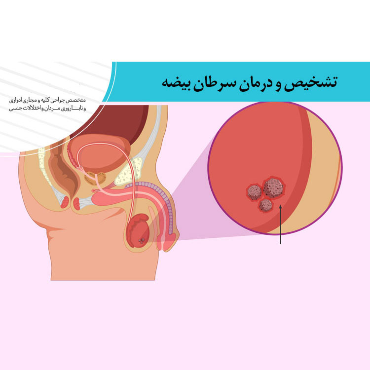 تشخیص و درمان سرطان بیضه