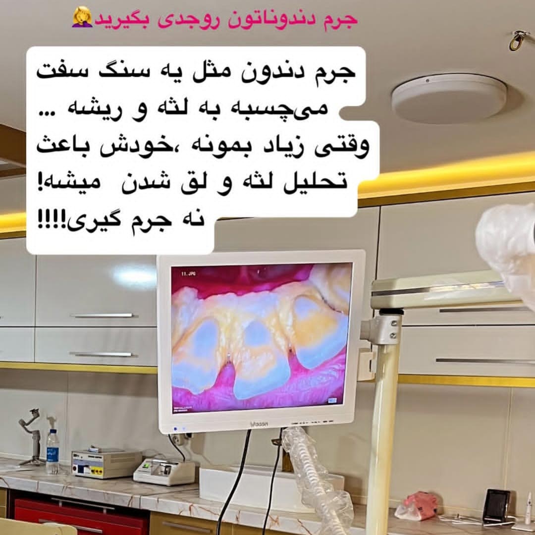 جرم دندون مثل یه سنگ سفت میچسبه به لثه