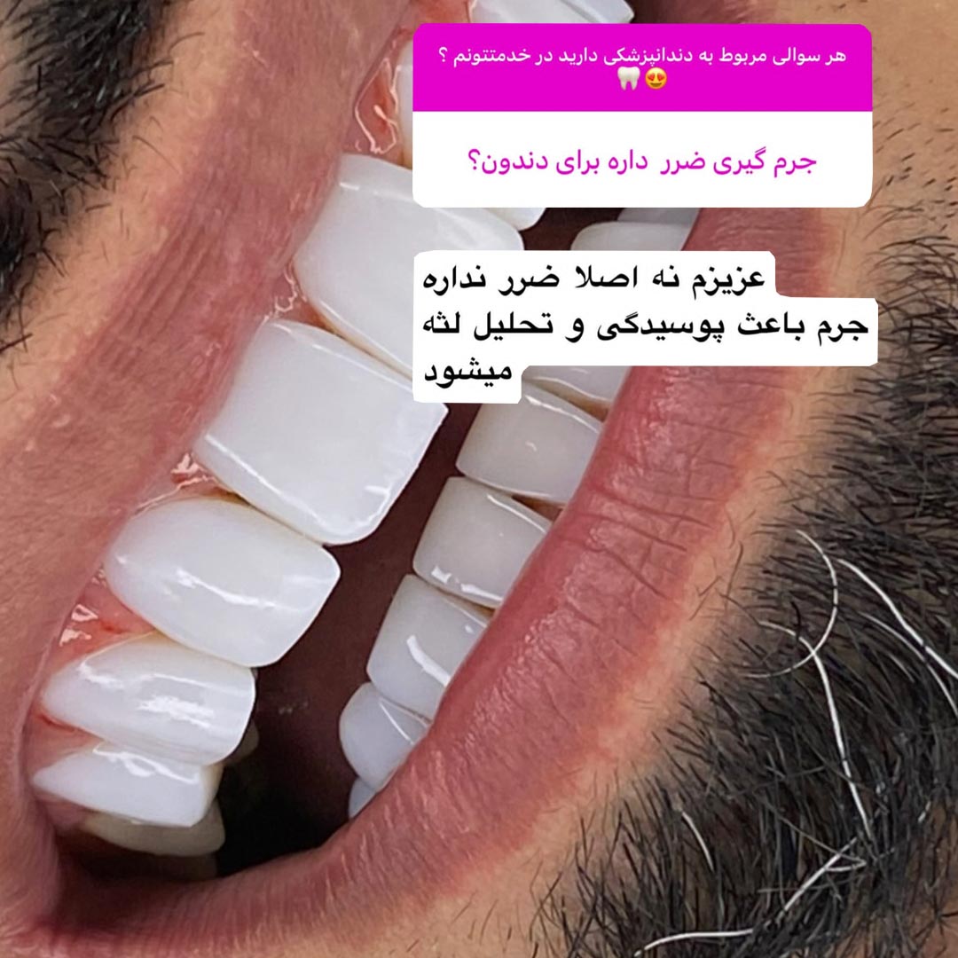 جرم گیری ضرر داره برای دندون یا خیر ؟
