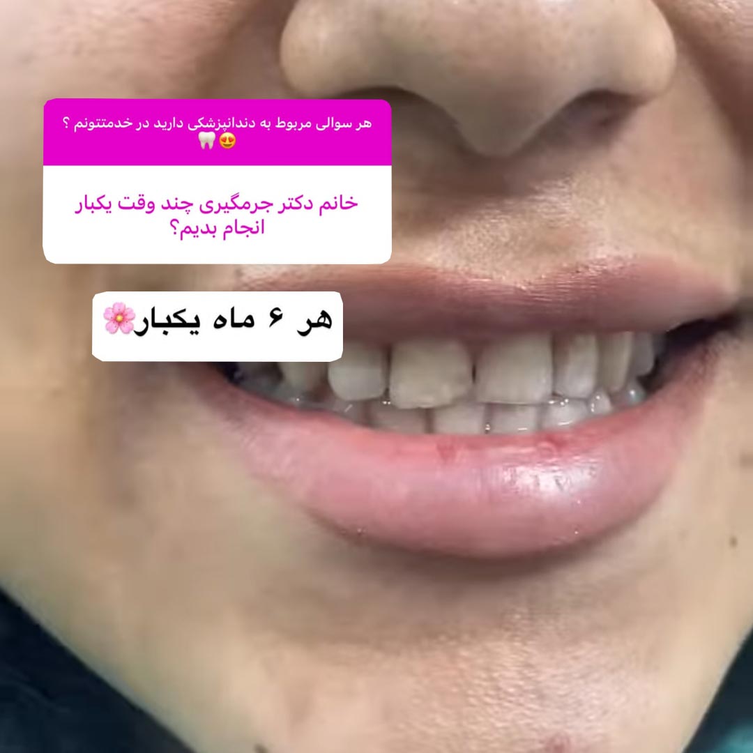 جرمگیری چند وقت یکبار انجام بدیم ؟