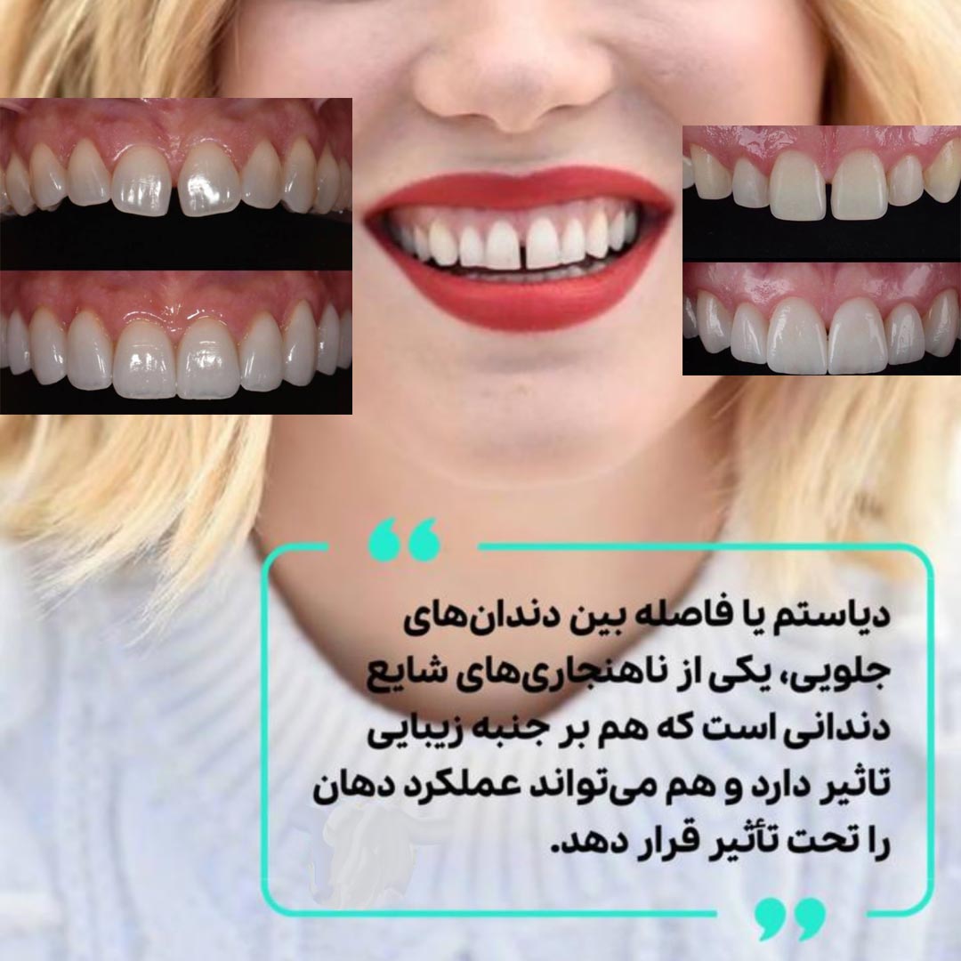دیاستم یا فاصله بین دندان + دلیل + درمان