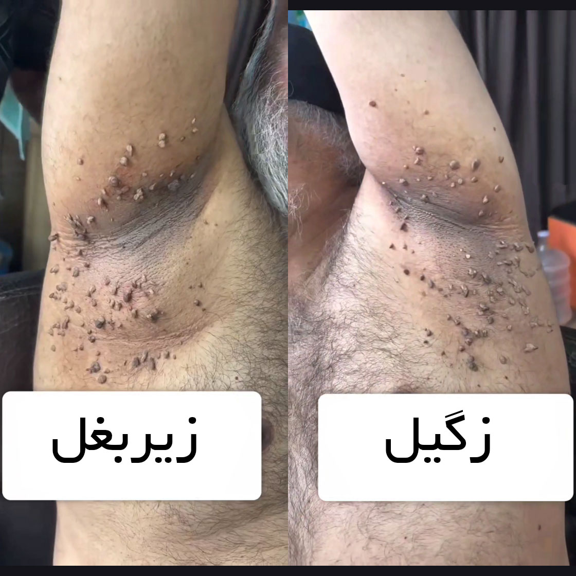 زگیل زیر بغل چیست ؟ + عکس در مردان