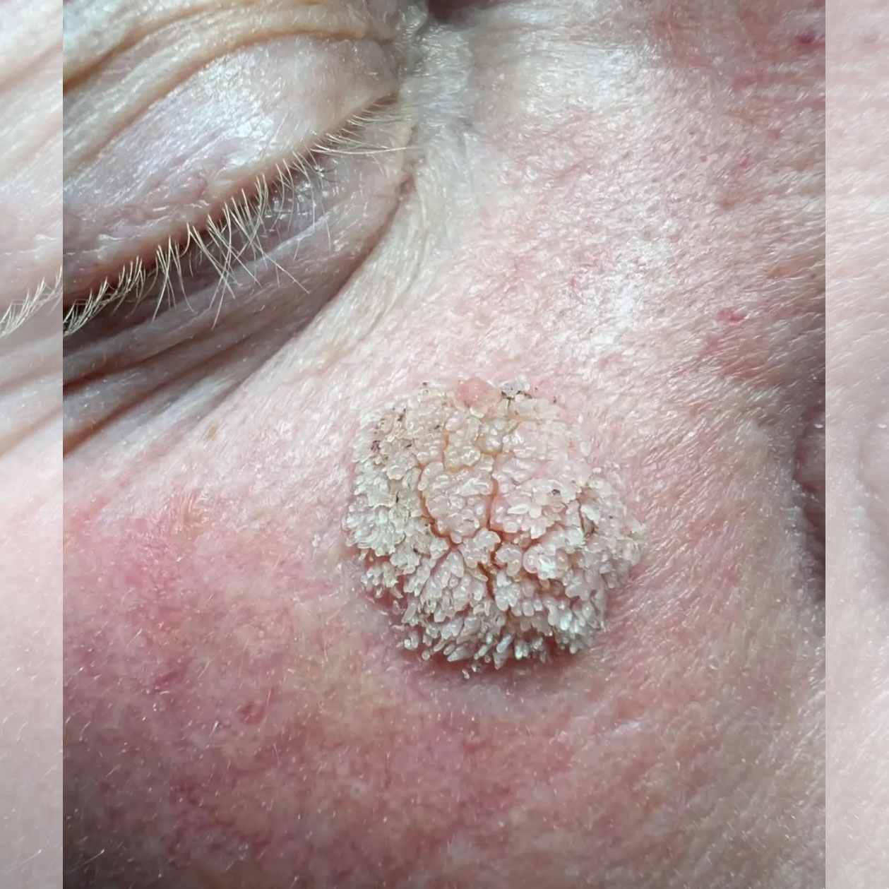 زگیل فیلی فرم ناحیه صورت روی گونه زیر چشم