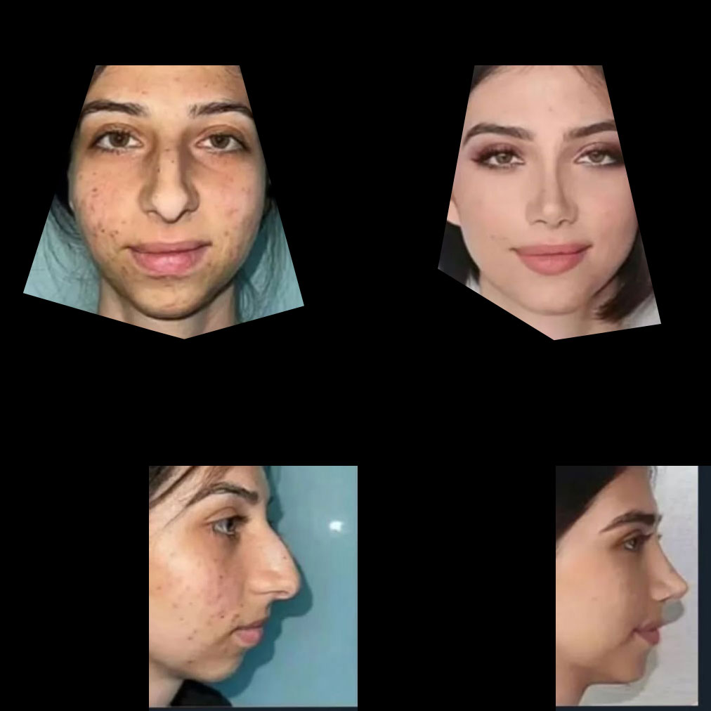 عمل زیبایی صورت زنان قبل و بعد – بزرگترین عمل جراحی تغییر چهره