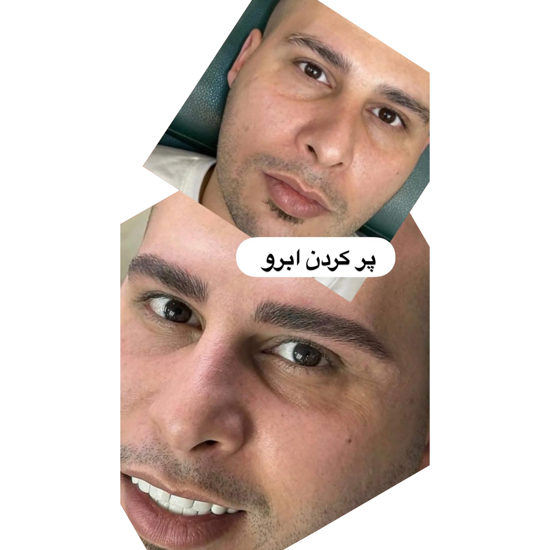 عوارض میکروبلیدینگ ابرو