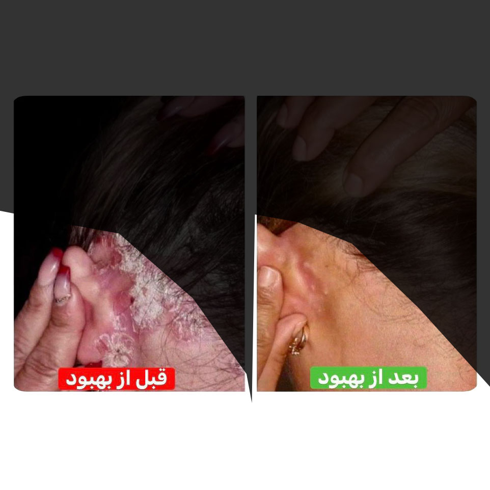 عکس بیماری پسوریازیس سر + قبل از بهبود و بعد از بهبود
