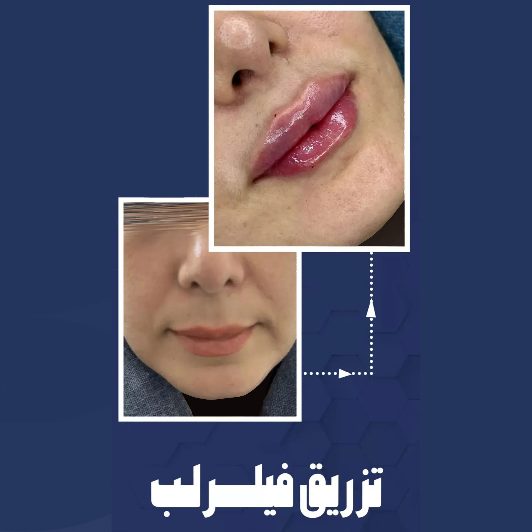 عکس تزریق ژل لب نیم سی سی + تزریق فیلر لب