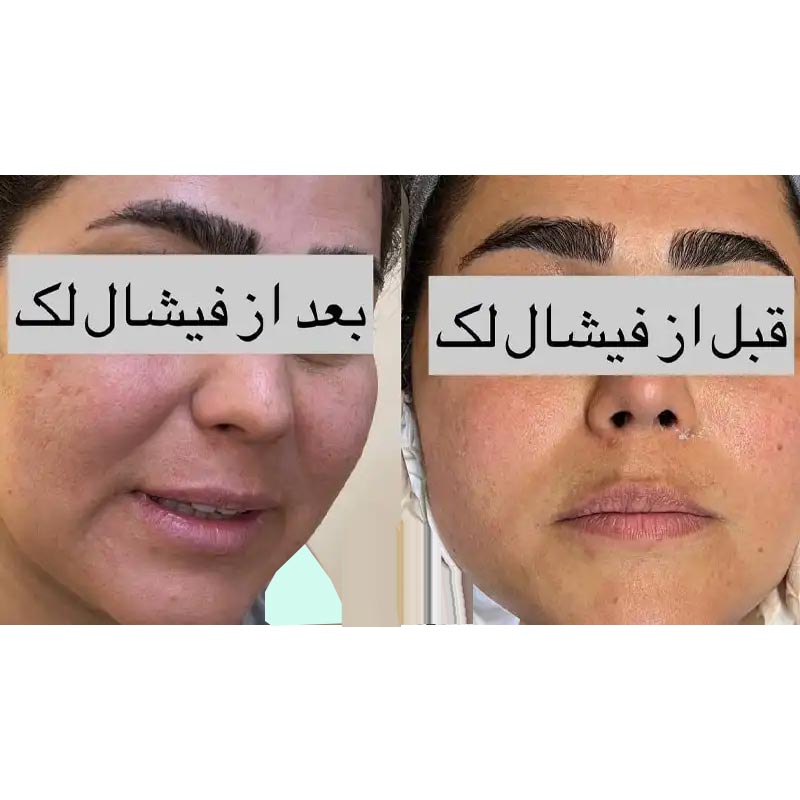 عکس فیشیال صورت قبل و بعد