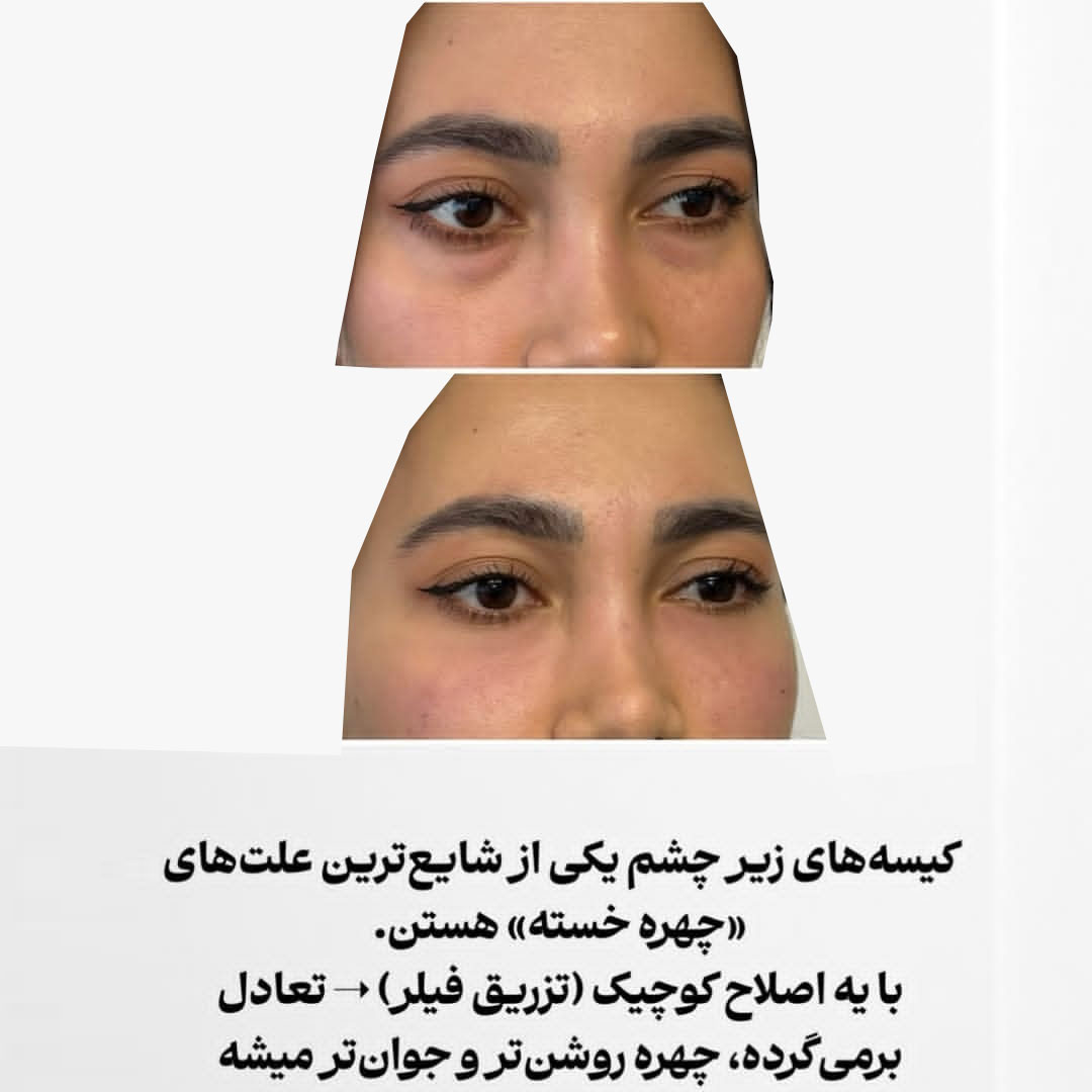 عکس فیلر زیر چشم = درمان چهره خسته و صورت روشن تر و جوان تر