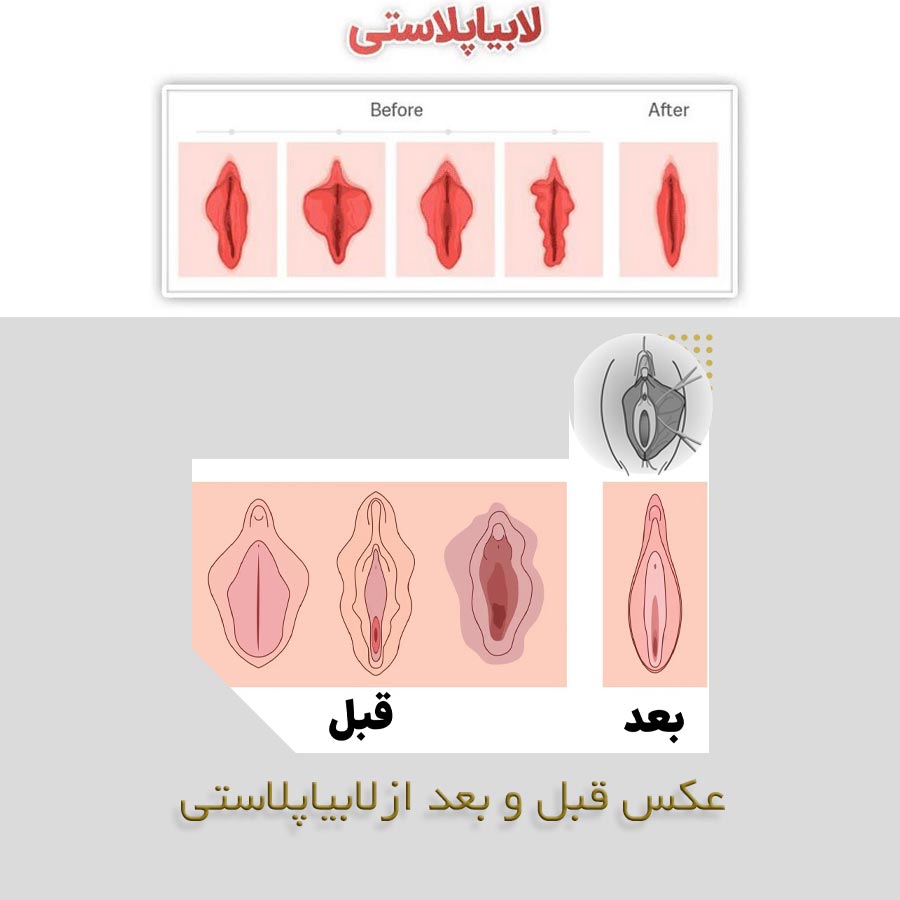 عکس قبل و بعد از عمل لابیاپلاستی