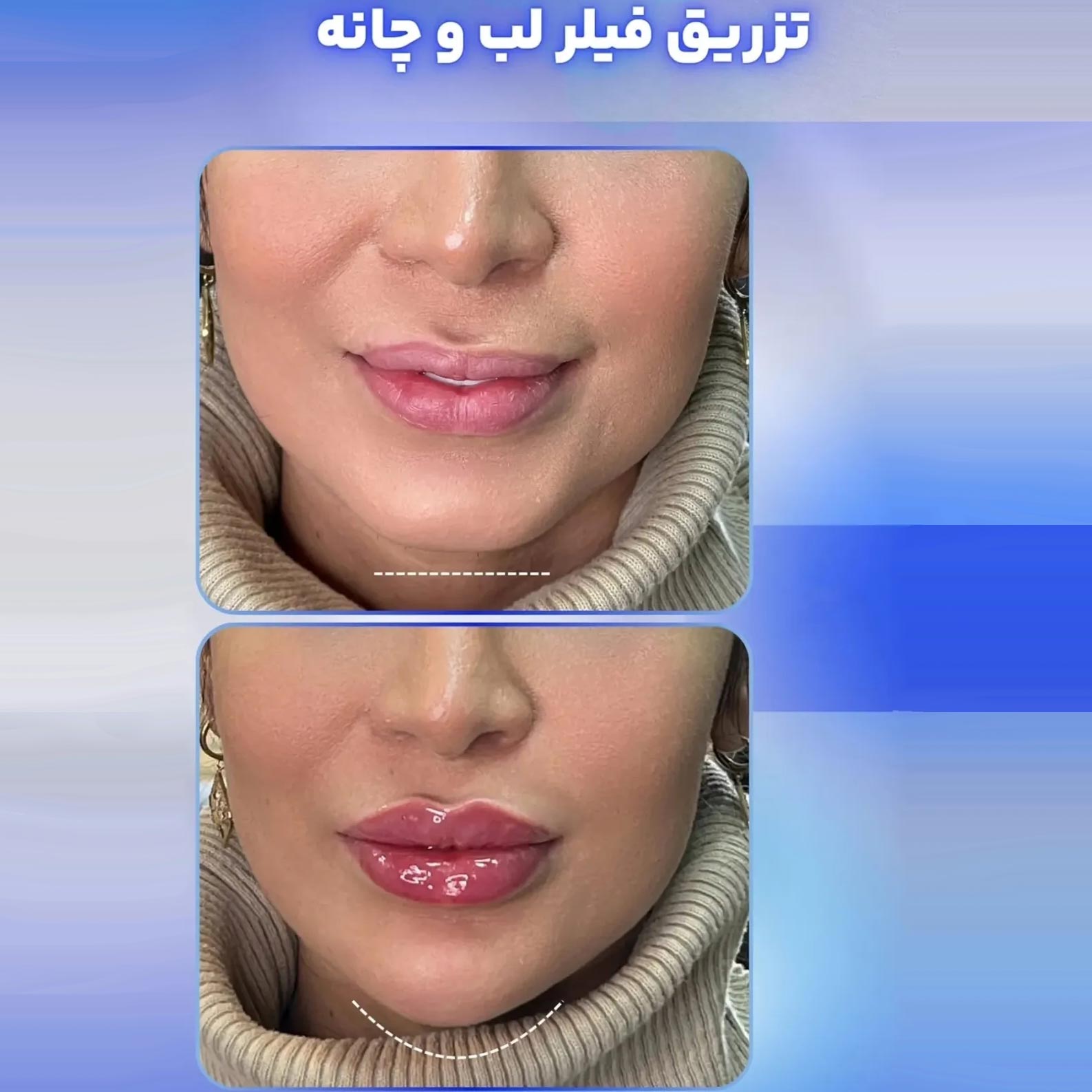 عکس قبل و بعد تزریق بهترین ژل فیلر لب و چانه + برای صورت کشیده