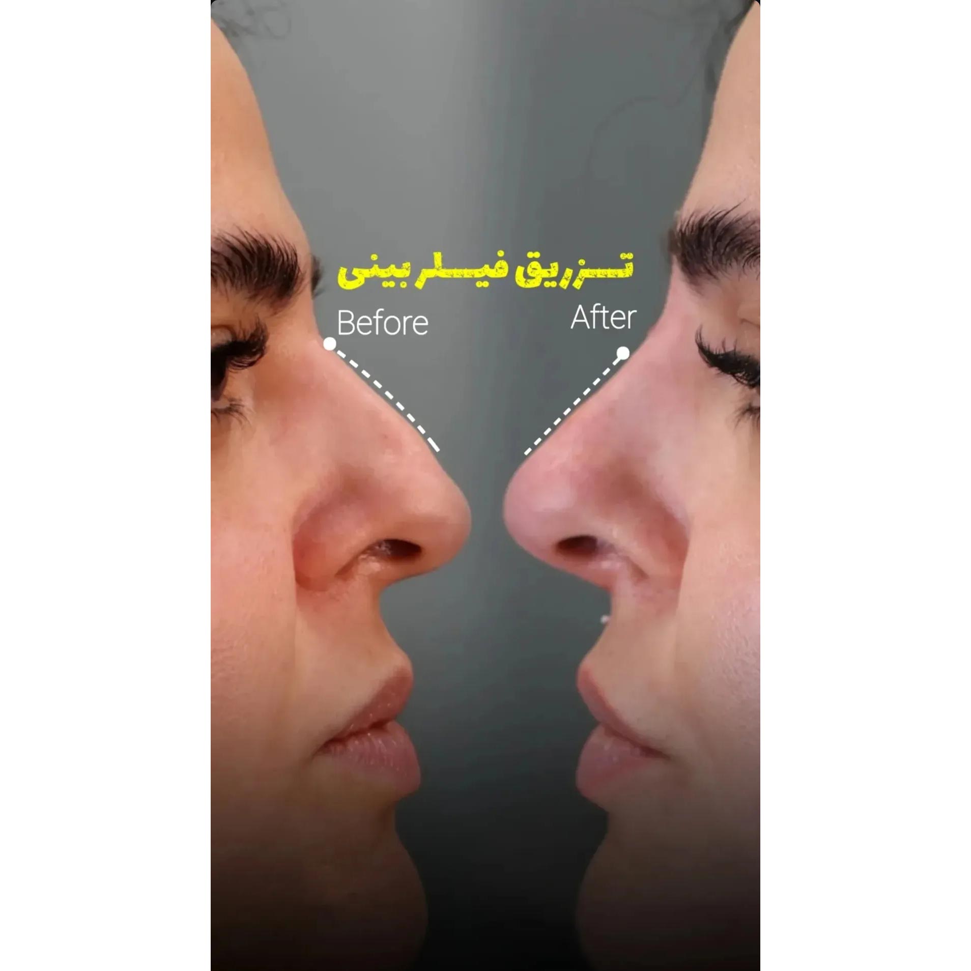 عکس قبل و بعد تزریق فیلر بینی عقابی