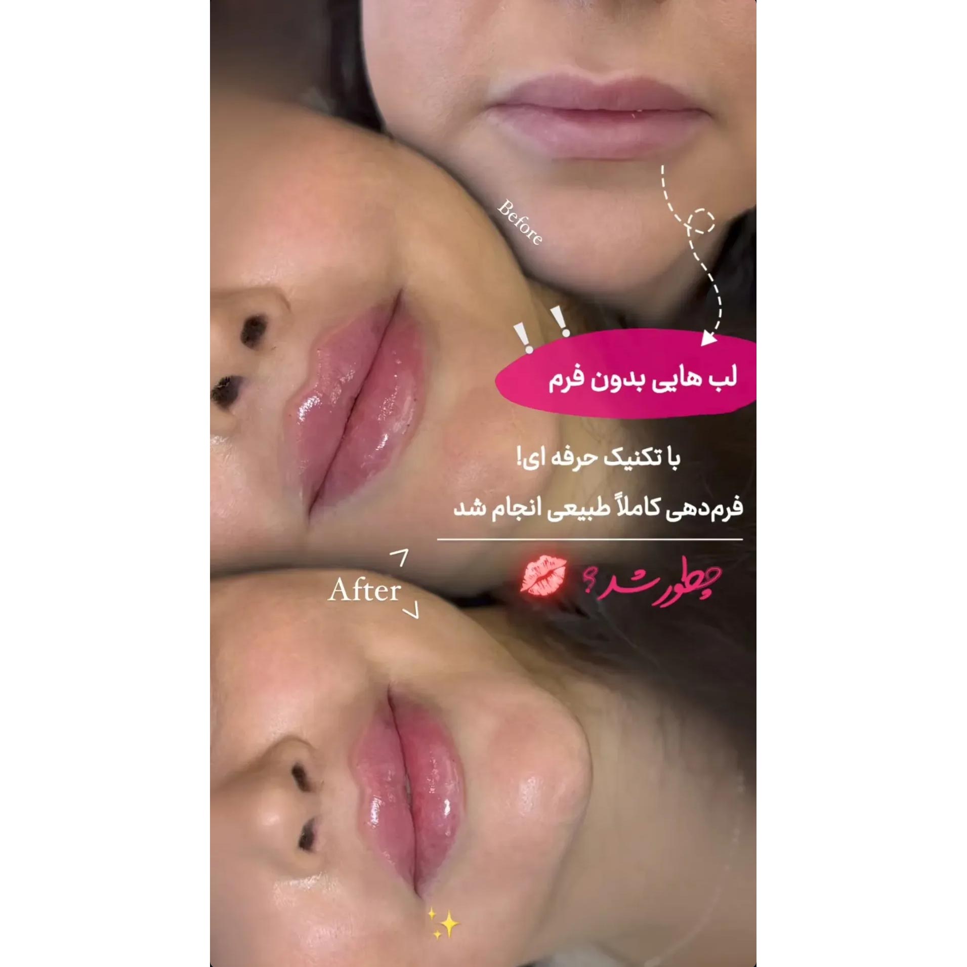 عکس قبل و بعد تزریق فیلر لب نچرال طبیعی
