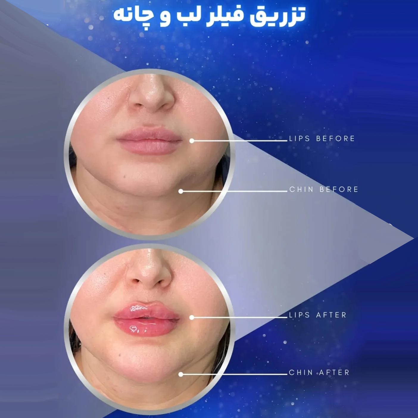 عکس قبل و بعد تزریق فیلر لب و چانه + ژل چانه برای صورت گرد