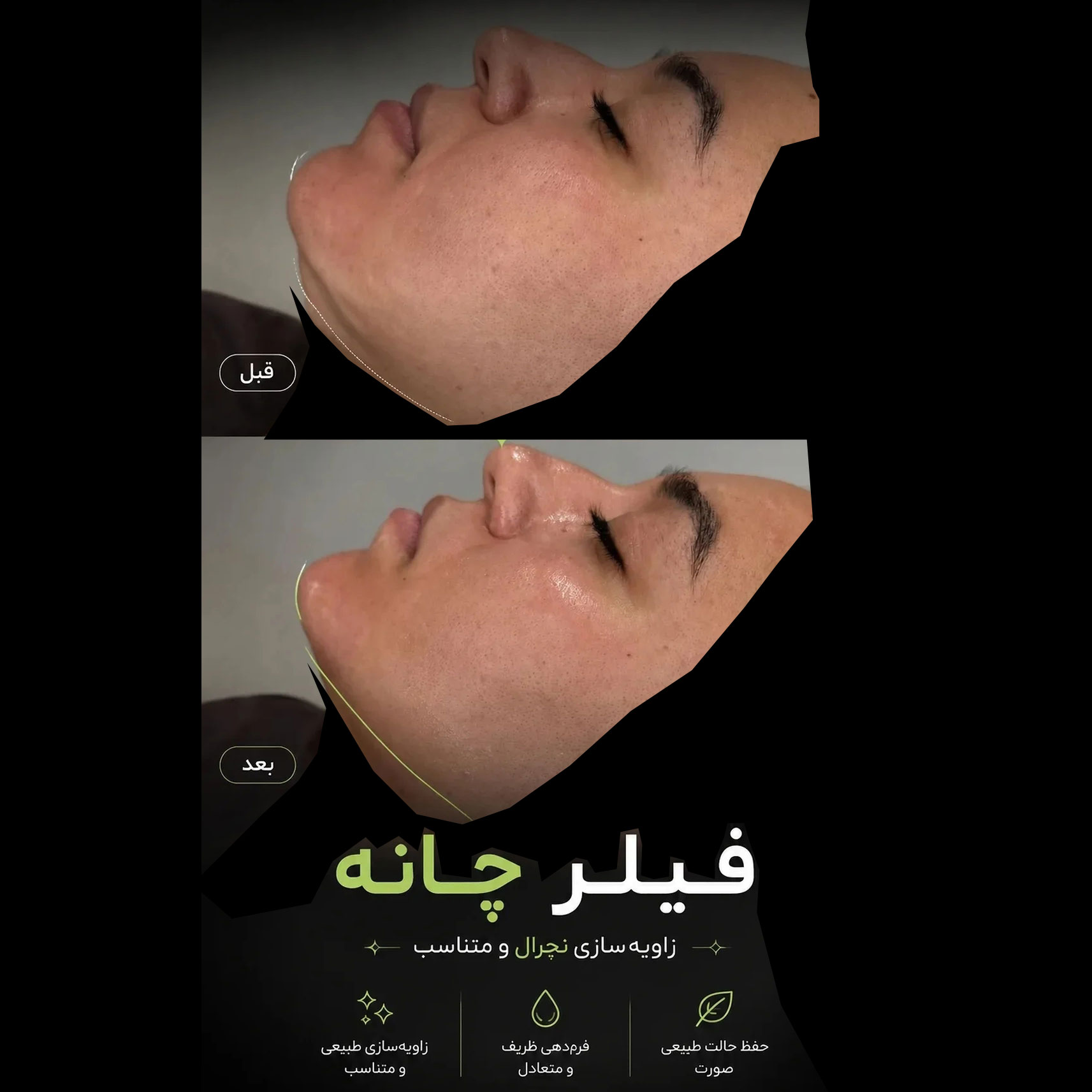 عکس قبل و بعد فیلر چانه با زاویه سازی نچرال و فرم دهی ظریف