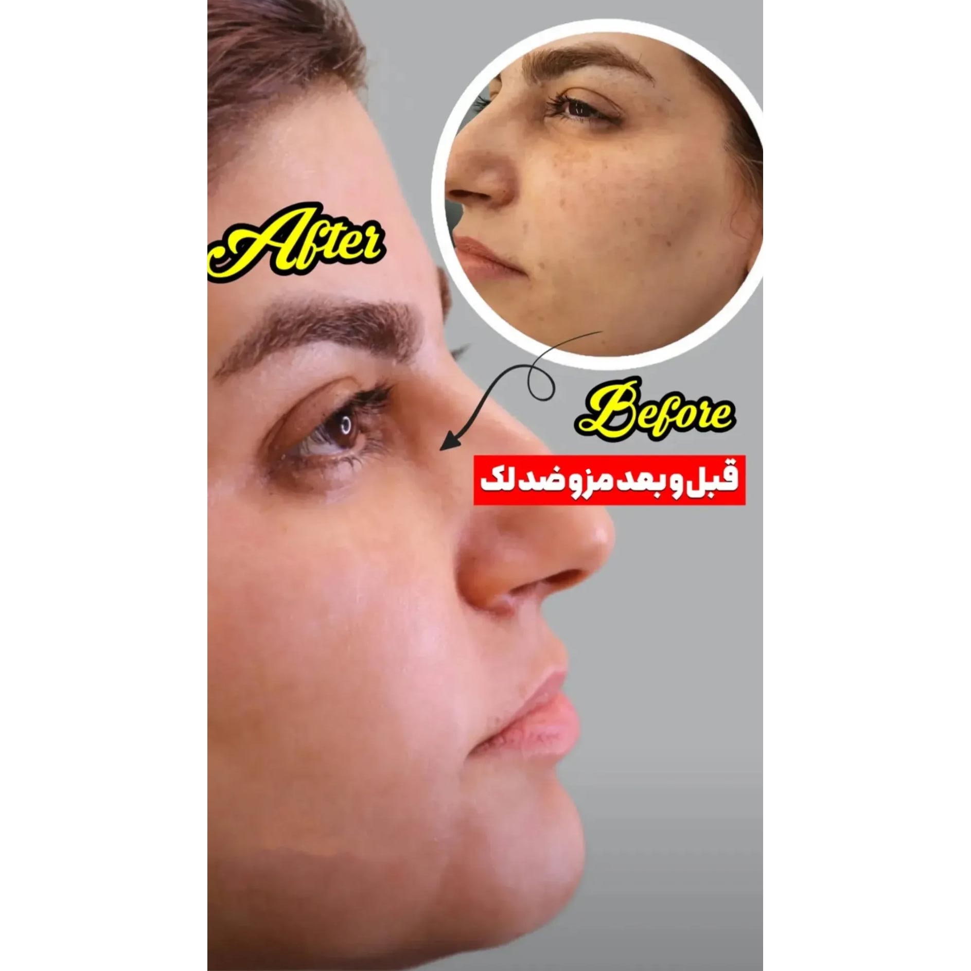عکس قبل و بعد مزوتراپی ضد لک صورت
