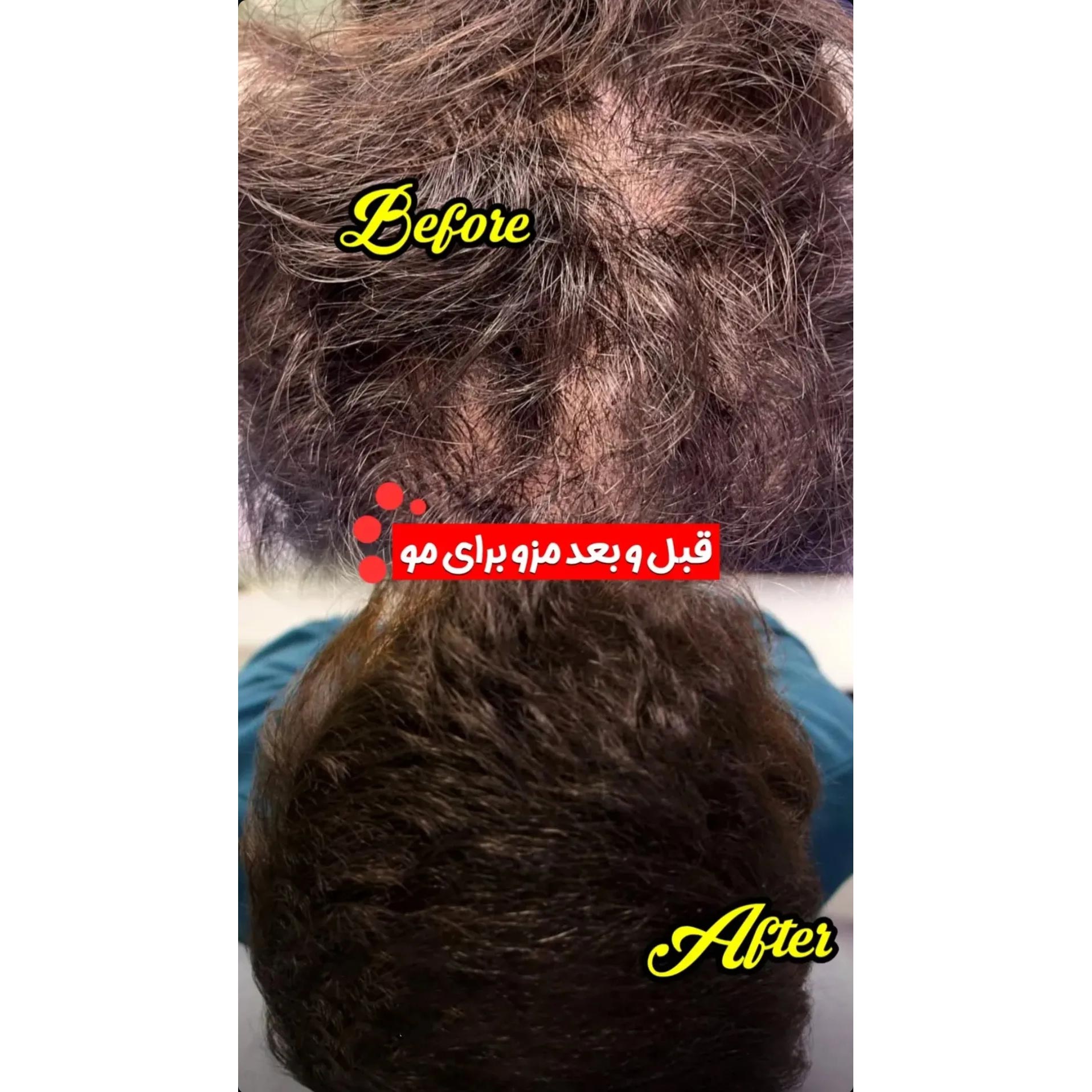 عکس قبل و بعد مزوتراپی مو برای آقای کم پشت