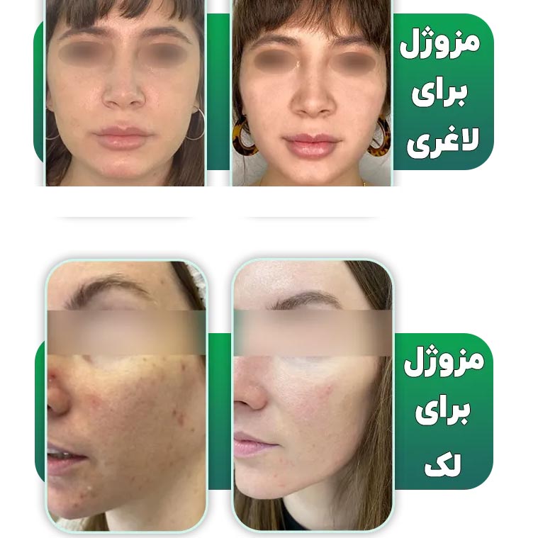 عکس قبل و بعد مزوژل صورت