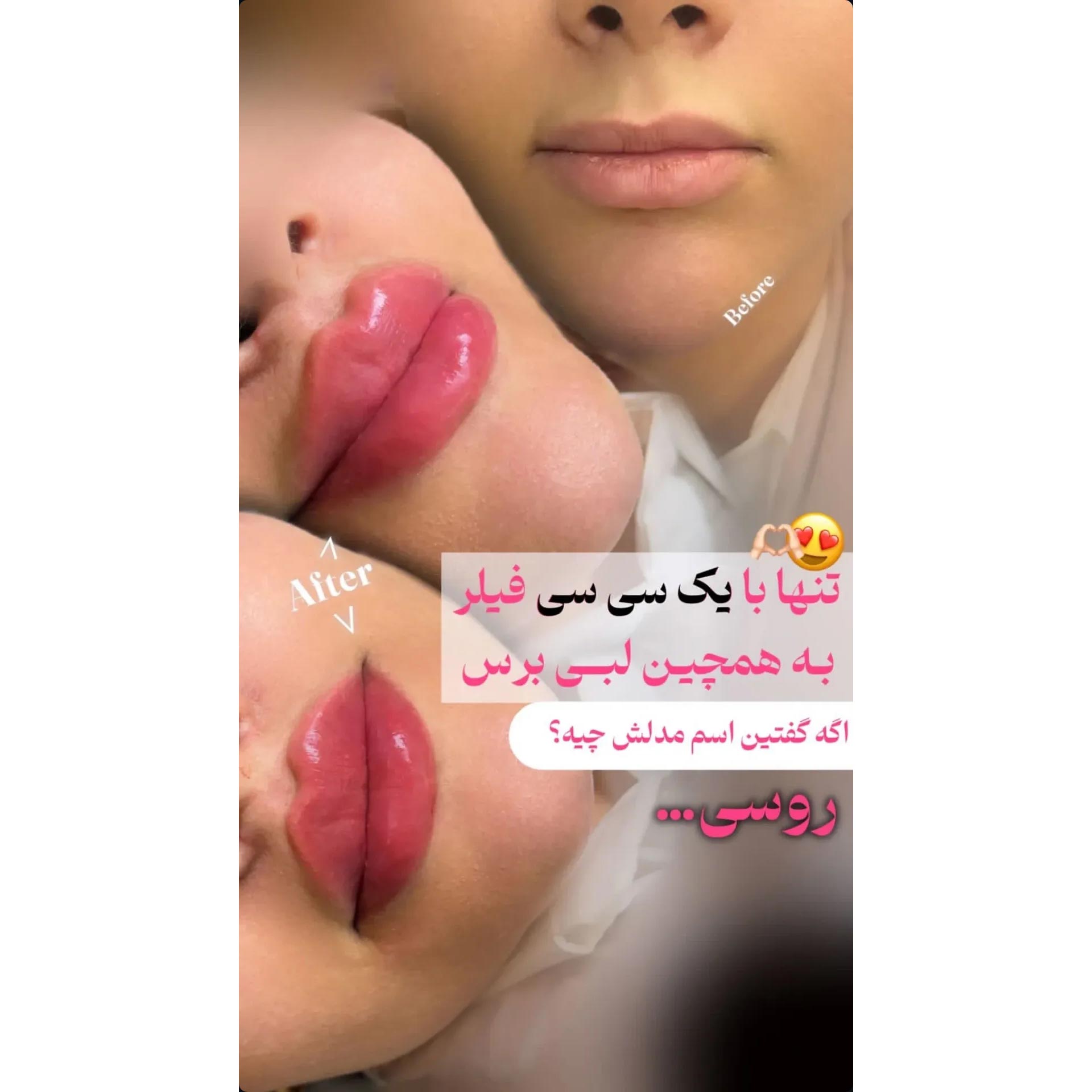 عکس قبل و بعد یک سی سی فیلر لب روسی