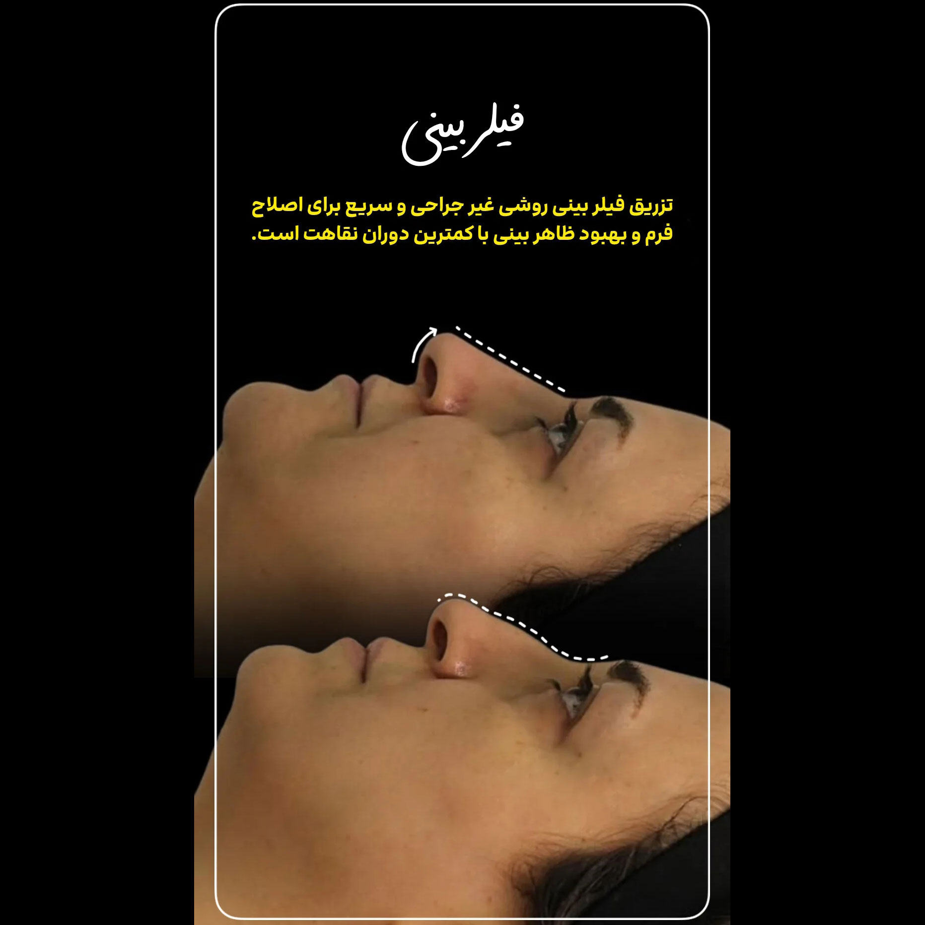 فیلر بینی خانم 41 ساله + عکس قبل و بعد