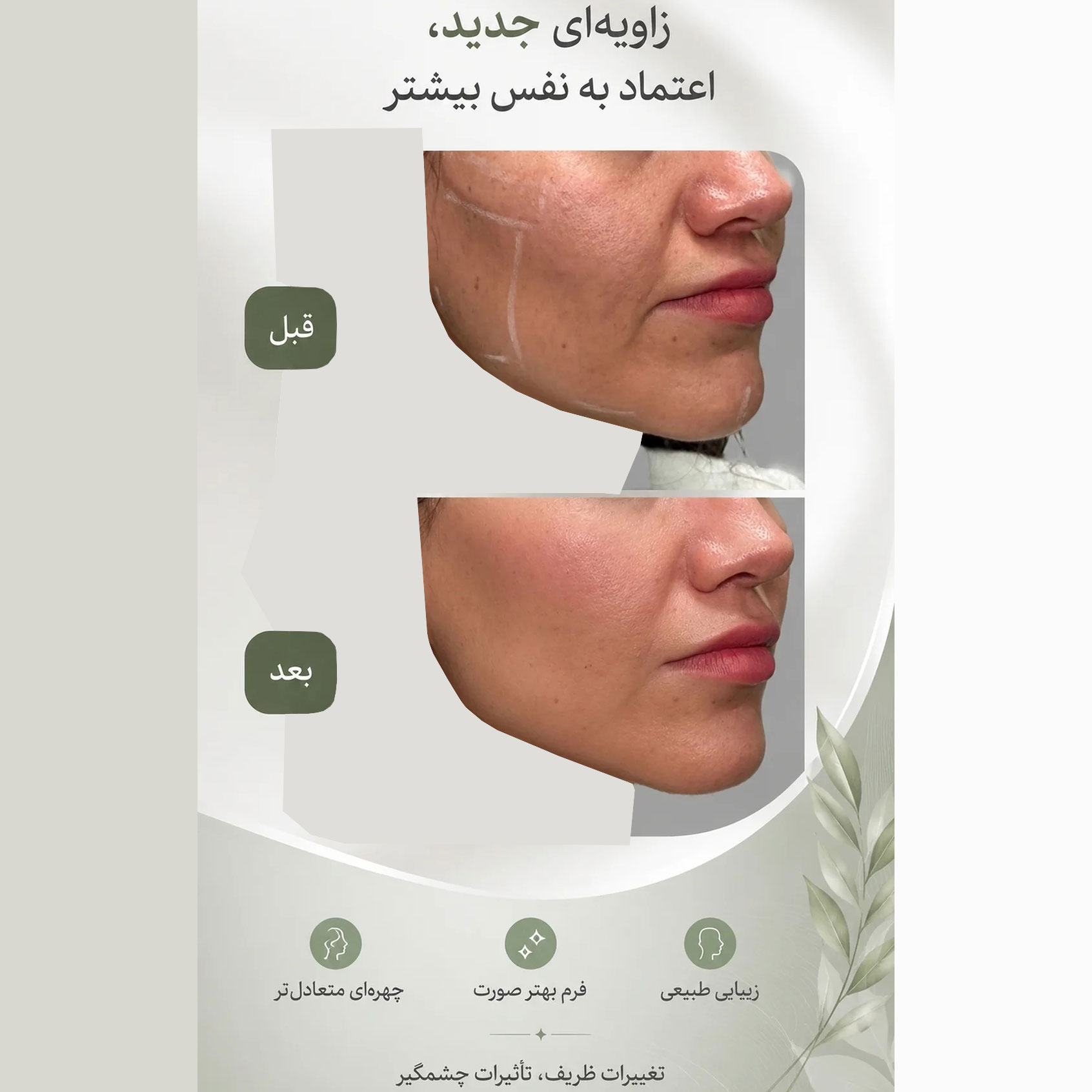 فیلر زاویه سازی فک خانم 42 ساله + فرم بهتر صورت با تغییرات ظریف