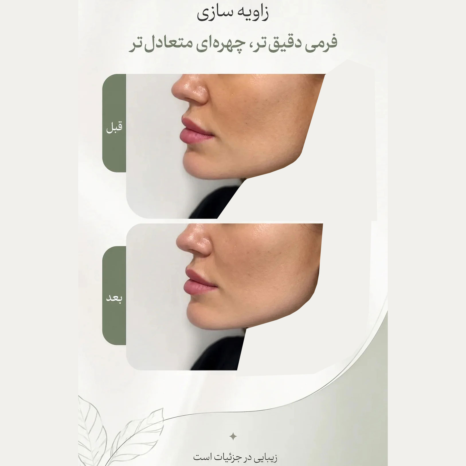 فیلر زاویه فک خانم 39 ساله + زاویه سازی فک با فرمی دقیق تر و چهره ای متعادل تر