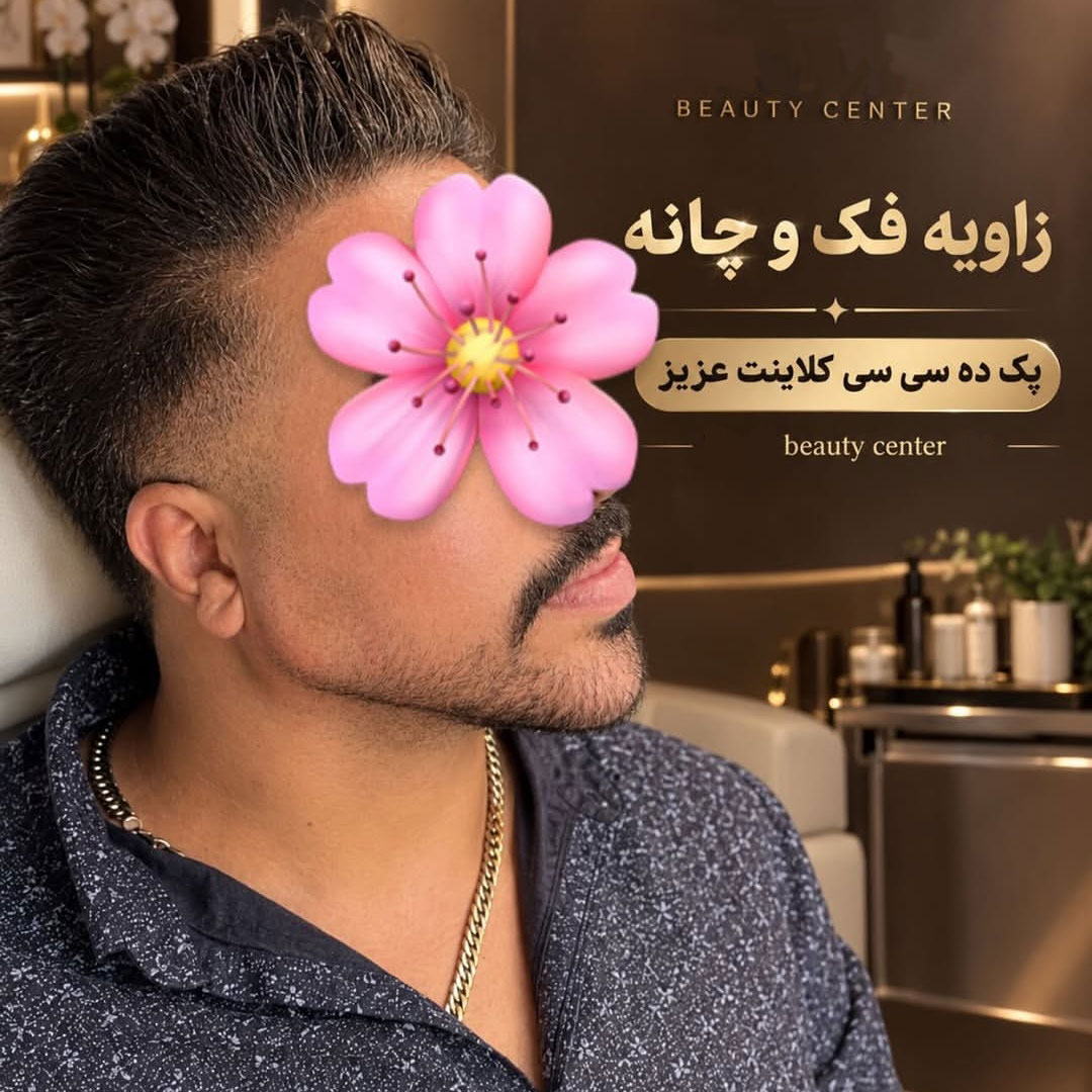 فیلر زاویه فک و فیلر چانه با حجم 10 سی سی برای آقا 26 ساله