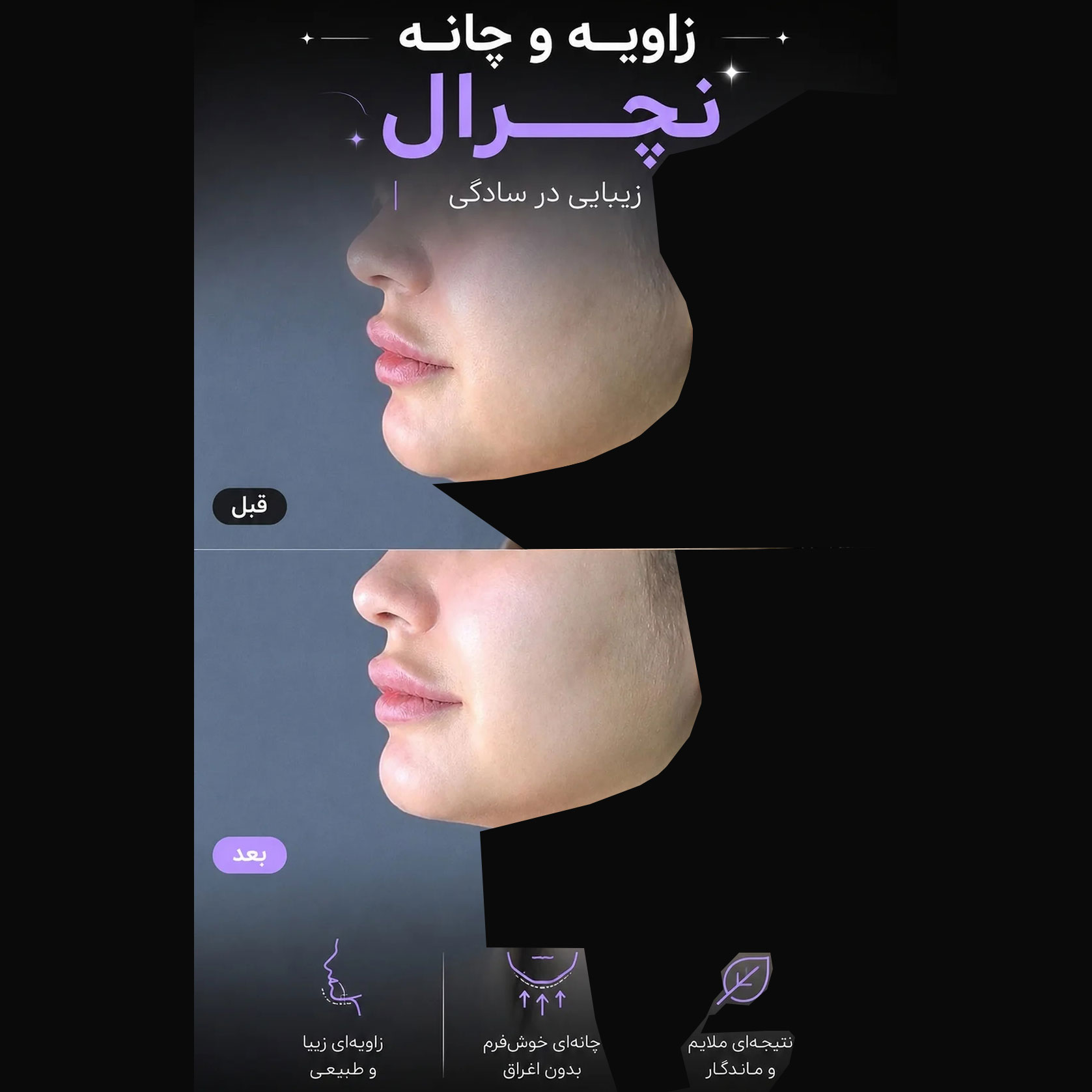 فیلر زاویه فک و چانه طبیعی نچرال + دختر 23 ساله