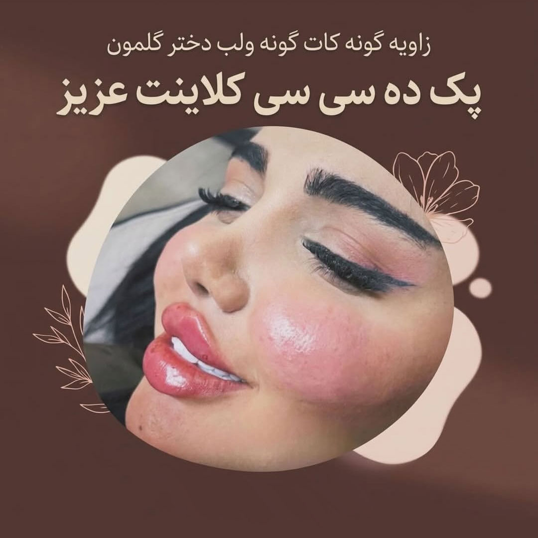 فیلر زاویه گونه و کات گونه و لب دخترونه + فیلر پک 10 سی سی