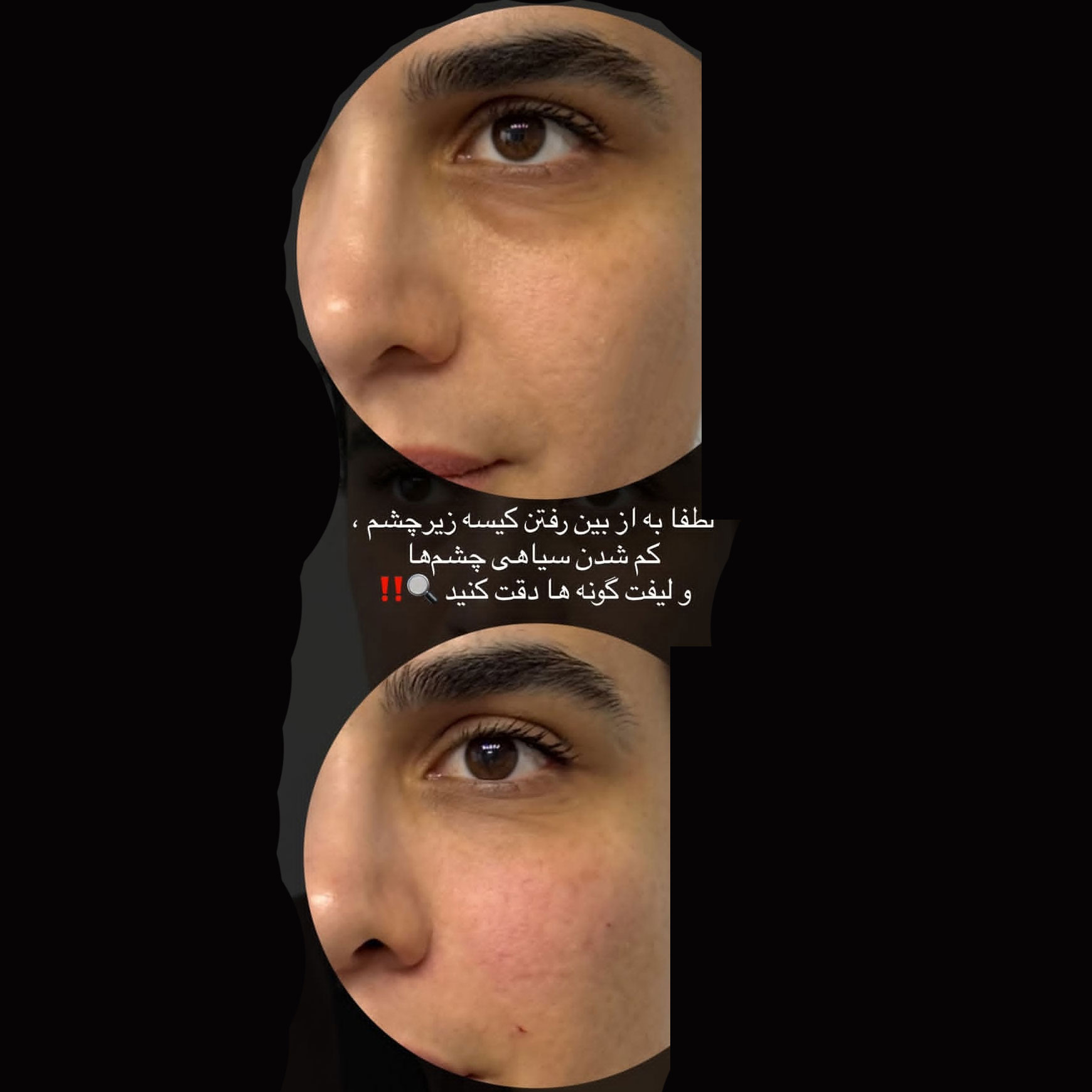 فیلر زیر چشم برای از بین رفتن کیسه زیر چشم کم شدن کودی و سیاهی و لیفت گونه