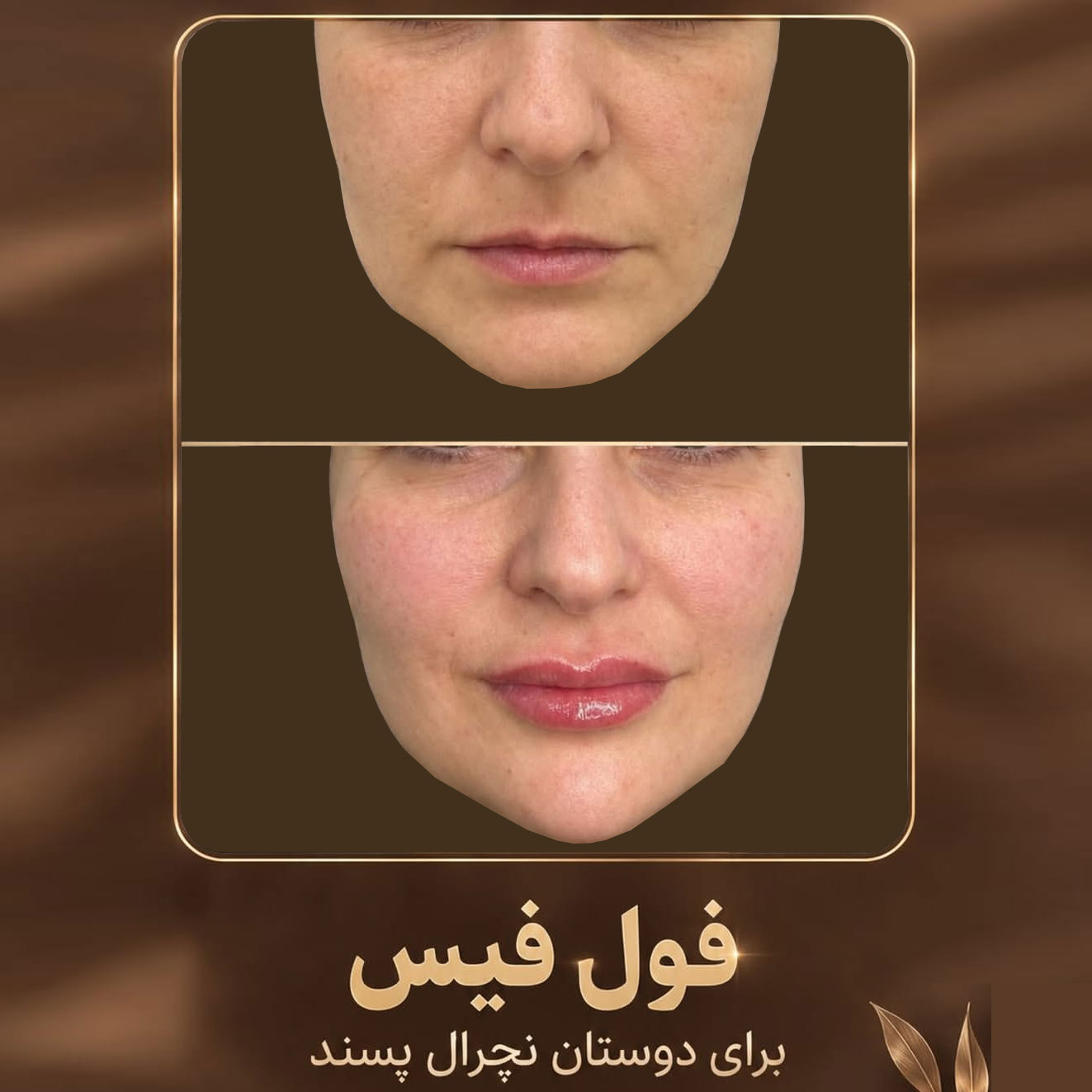 فیلر فول فیس برای خانم 40 ساله مدل نچرال با عکس قبل و بعد