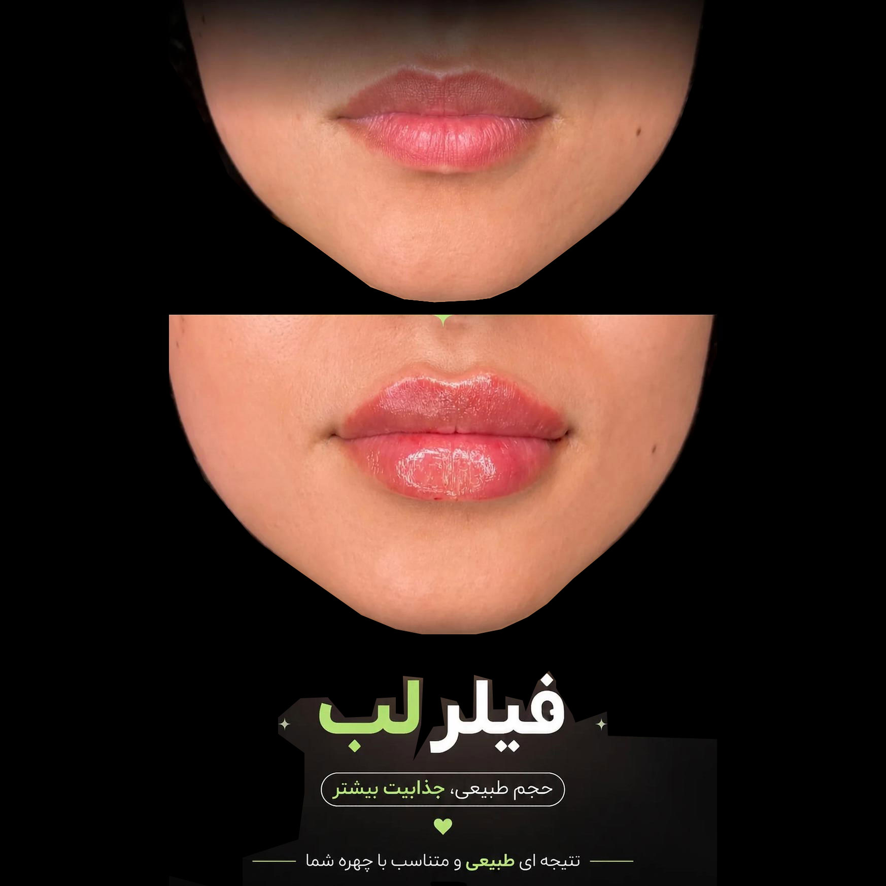 فیلر لب با حجم طبیعی و نتیجه ای طبیعی