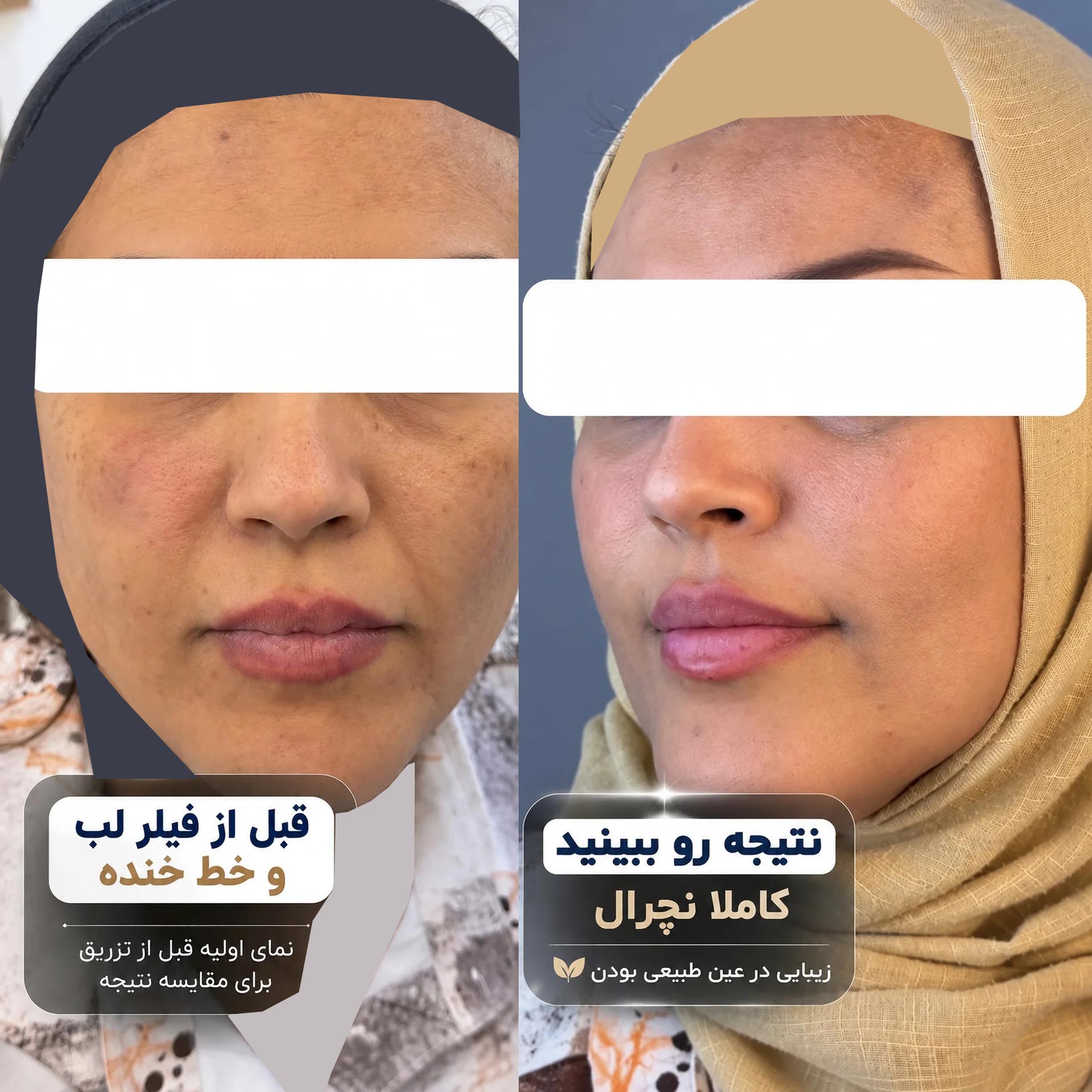 فیلر لب و فیلر خط خنده خانم 50 ساله کاملا نچرال