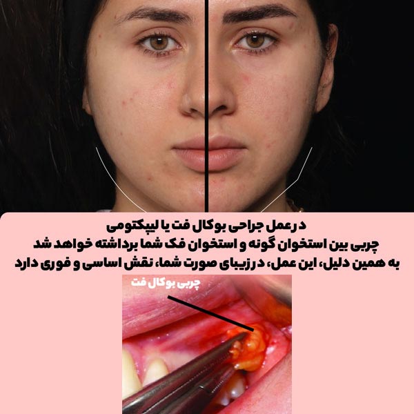قبل و بعد بوکال فت