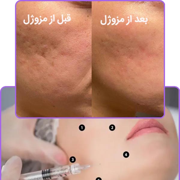 قیمت مزوژل صورت