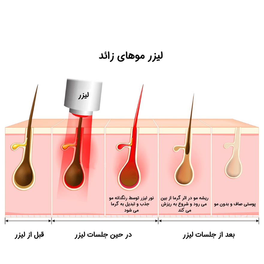 لیزر موهای زائد برای چه کسانی ضرر دارد ؟