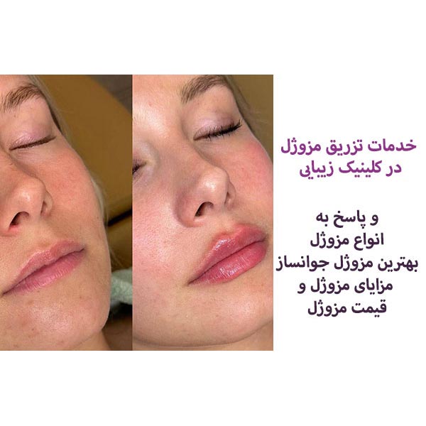 ماندگاری مزوژل