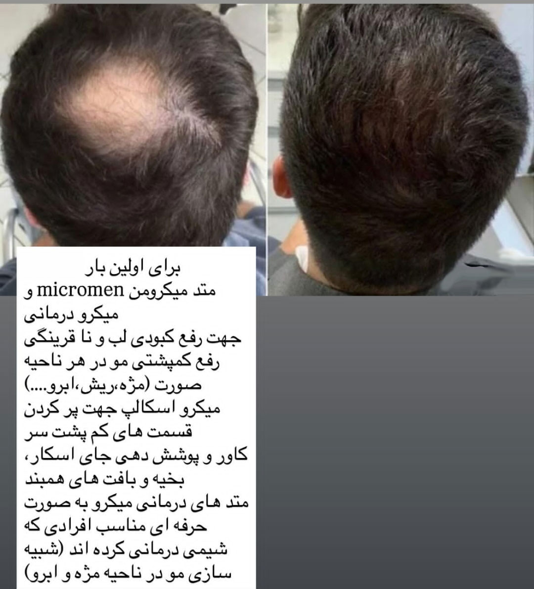 میکروبلیدینگ سر مردانه موی سر